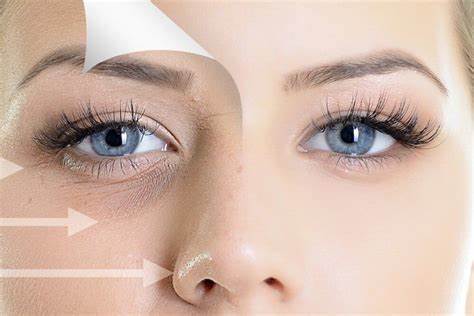 Which Filler is the Best for Under the Eyes